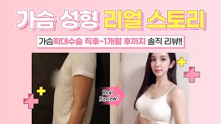 가슴확대수술 후기?! 직후~1달후까지 솔직 리뷰~ 유방외과 가슴 성형 수술 후기 [맘스외과]