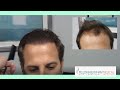 Repair of FUE Hair Transplant | Feller & Bloxham Medical | NY, NYC, Long Island & Philadelphia