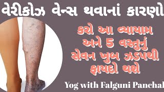 વેરીકોઝ વેન્સ થવાના કારણો.આ વ્યાયામ અને 5 વસ્તુઓનું સેવન કરો