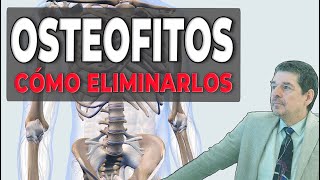 🎥 Osteofitos: Qué son y cómo combatirlos de manera natural 🦴❌