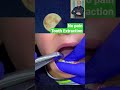 no pain tooth extraction خلع الاسنان بدون ألم