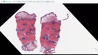 Lecture 6-Subepidermal Vesiculobullous Disorders