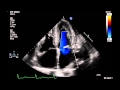 Rule out cardiac amyloidosis. 2D Echocardiogram w Doppler