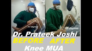 KNEE MANIPULATION UNDER ANAESTHESIA (MUA) - DR. PRATEEK JOSHI | KNEE STIFFNESS |