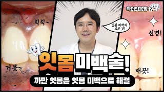 까만잇몸, 검은 잇몸 완전해결 !! 💪 [잇몸미백]의 모든 것