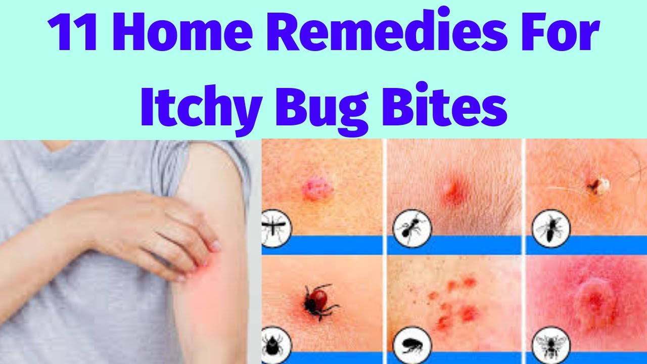 11 Home Remedies For Itchy Bug Bites - YouTube