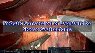 Robotic Gastric Lap Band converted to Gastric Sleeve Surgery with narration.