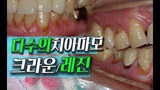 다수의 치아 마모 크라운/레진 치료