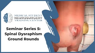 Seminar Series 5: Spinal Dysraphism - Ground Rounds