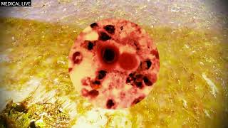 Cryptococcus gattii infection