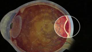 Retinal Detachment Rife Healing Frequency | Isochronic Binaural Beats Music - Rife Treatment 15 Min