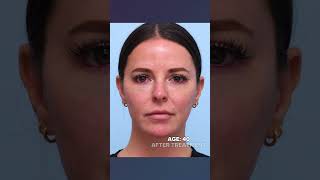 What Happens to Fillers Over Time?