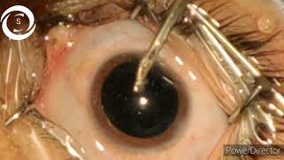 Phaco in HD quality in soft cataract