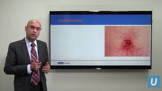 Fabry's Disease: What You Should Know | Anjay Rastogi, MD, PhD | UCLAMDChat