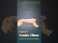 Mill's test for tennis elbow - lateral epicondylitis