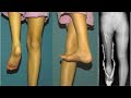 Rotationplasty for Bone Cancer: When the Ankle Becomes a Knee