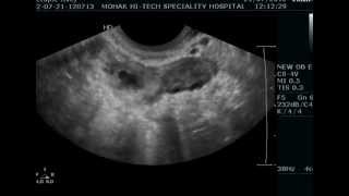 Live Ectopic Pregnancy in the right tube