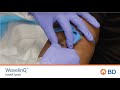 BD WavelinQ™ EndoAVF Cannulation Quick Training (with patient)