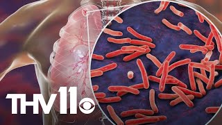 Kansas experiencing one of biggest Tuberculosis outbreaks in nation