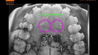 Palatal TADS intrusion video