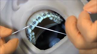 Elm Tree Orthodontics |  Flossing with Braces