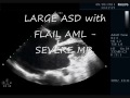 ASD with MR(RHD)-ECHO CARDIOGRAPHY SERIES BY DR ANKUR K. CHAUDHARI.