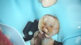 Occlusal reduction \u0026 dismantling burs