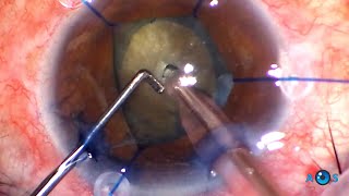 Phaco Chop the Hypermature Cataract with prior Phacolytic Glaucoma