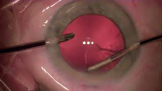 Cataract Surgery with Oertli Faros