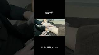 硬化療法・網の目クモの巣静脈瘤【さいたま静脈瘤クリニック】