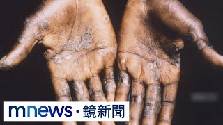 醫曝猴痘仍會重症　4款抗病毒藥物「積極洽談」｜#鏡新聞