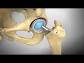 hip animation from zimmer biomet