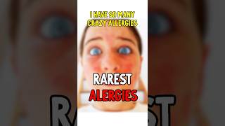 Rarest Allergies 🤧 do I have them all? *subscribe for updates* #norrisnuts