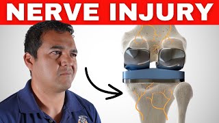 Most Common Type Of Nerve Injury After Knee Replacement Surgery