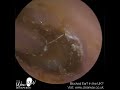 1 379 long procedure to treat complex outer ear fungal infection