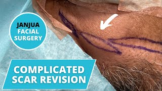 COMPLICATED SCAR REVISION ON THE FACE - DR. TANVEER JANJUA - NEW JERSEY