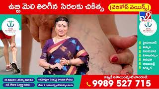 Best Varicose Veins Treatment | Avis Vascular Centre | Avis Hospitals - TV9