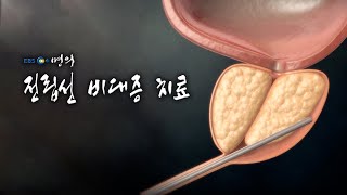 [명의 의학백과📖] 전립선 비대증 치료