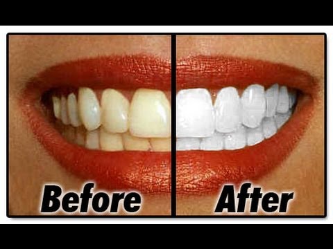 How To Whiten Your Teeth in Just 3 Minutes