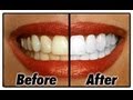 How I Whiten My Teeth At Home How I Whiten My Teeth At Home