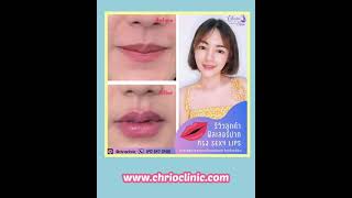 รวมรีวิว #ฟิลเลอร์ปาก ทรงปากสวย น่าจุ๊บ 💋 ิ #ละมุน🌸 ทรง #Sexy Lips|#ไครโอคลินิก #ChrioClinic