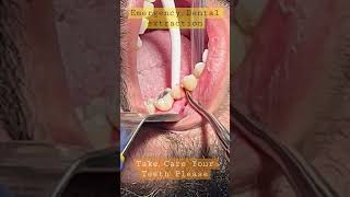 Emergency Tooth Extraction