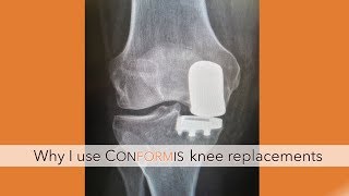Dr  Lindsey Knee Replacement Talk - ConforMIS Custom Knees