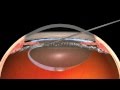 Victus Femtosecond Laser Cataract Surgery and Translens Hydrodissection