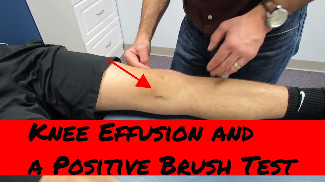 Knee Effusion Positive Brush Test And Intra Articular Knee Injury Eval