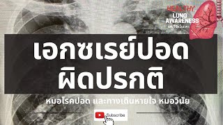 เอกซเรย์ปอดผิดปรกติ |สิ่งที่คุณต้องรู้ | นพ.วินัย โบเวจา