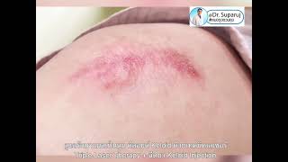 เทคนิคดูแลแผลเป็นนูน คีลอยด์ Keloid ด้วยเลเซอร์ Triple Laser Therapy+ ฉีดยา Keloid Injection Dr. Ruj