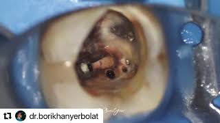 A clinical case shared by Dr. Yerbolat Borikhan with 𝐔𝐥𝐭𝐫𝐚 𝐗 and 𝐔𝐥𝐭𝐫𝐚𝐌𝐢𝐧𝐭 𝐏𝐫𝐨.