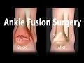 Ankle Fusion Surgery Animation