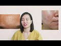 review chân thực kem chống nắng anessa có đủ bảo vệ da khi điều trị treatment nguyễn mai hương